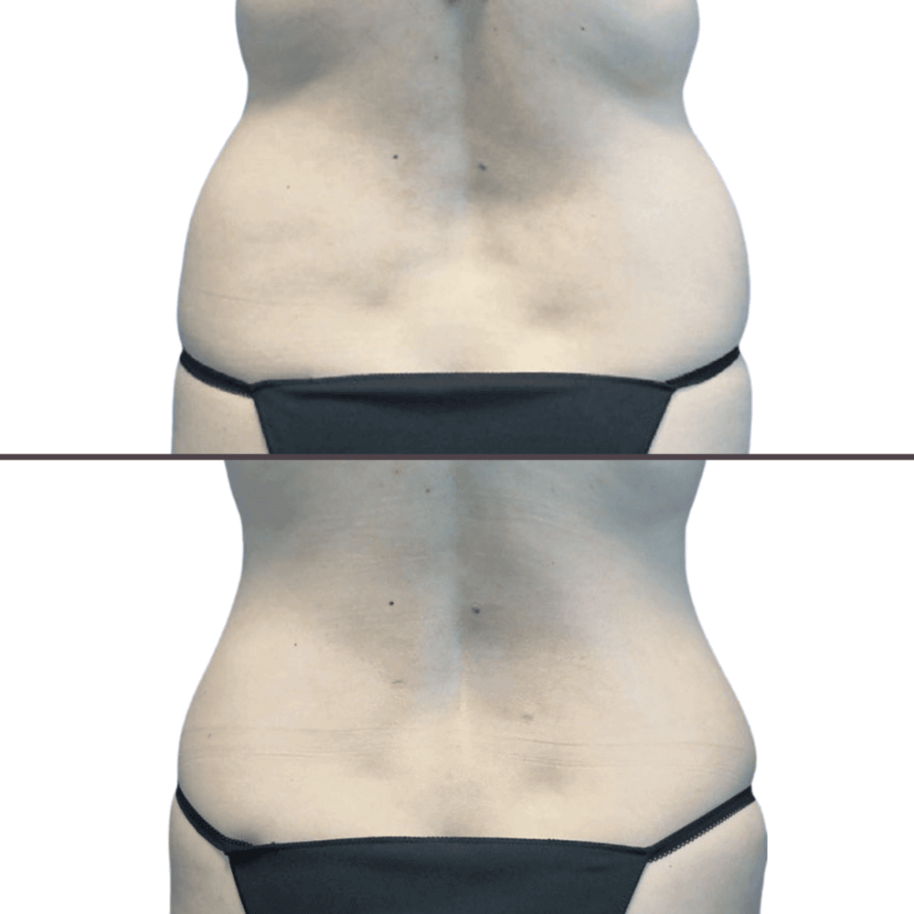 Liposuction before and after