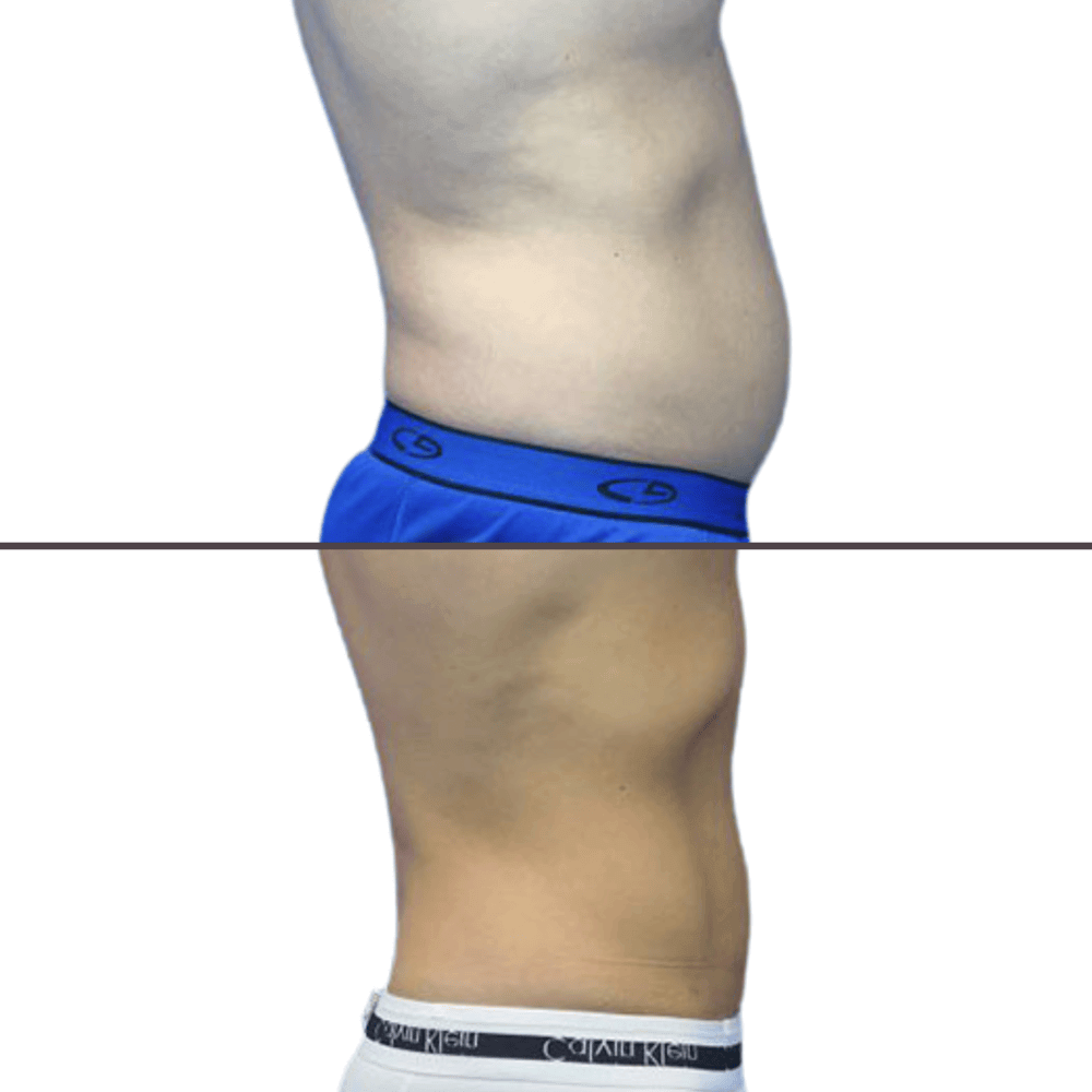 Liposuction before and after