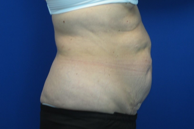 How to Ensure a Smooth Tummy Tuck Recovery and Great Results - Dr. Bartell  - Board Certified Plastic Surgeon - Madison WI