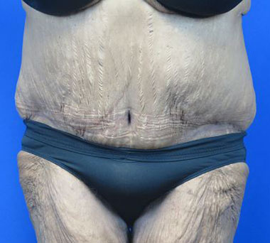 Milwaukee Tummy Tuck (Abdominoplasty)